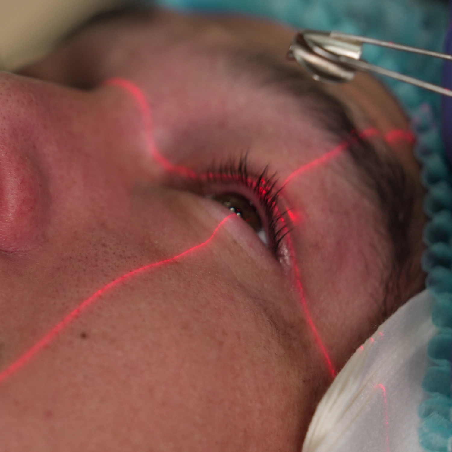 Laser Eye Surgery