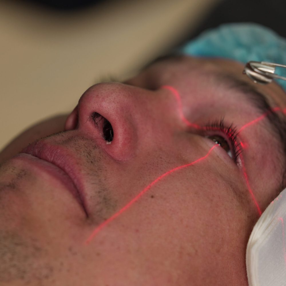 corneal cross linking treatment