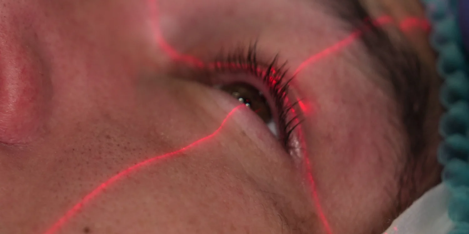Laser Eye Surgery